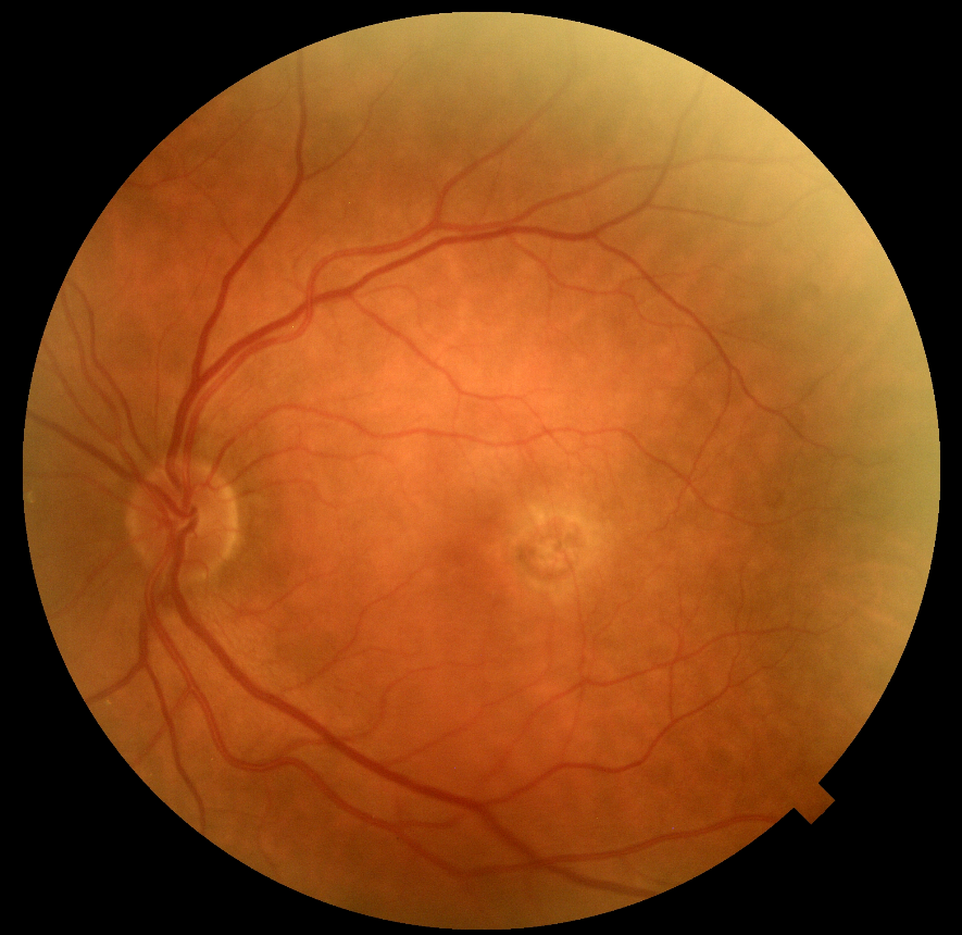 Fundus OCT