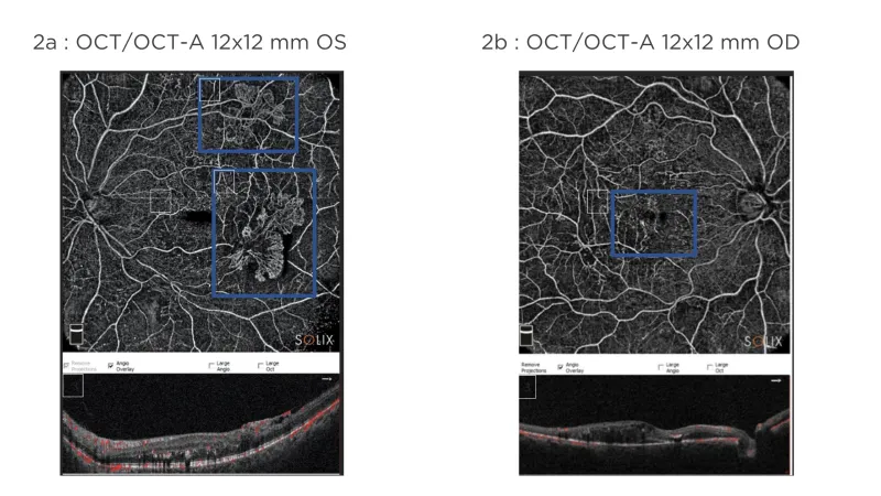 Figure 2a : OCT/OCT-A 12x12 mm OS; Figure 2b : OCT/OCT-A 12x12 mm OD