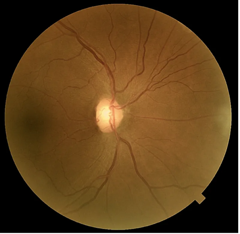 épaisseur gcc de l'œil droit 