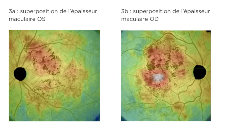 Figure 3 : Superposition de l'épaisseur maculaire OS et OD