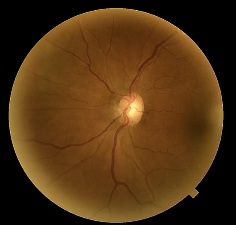 épaisseur gcc de l'œil gauche